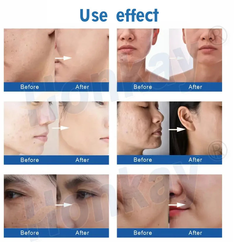 8 in 1 Oxygen Jet Peel Machine for Intense Hydration Wrinkle Removal and Restore the Elasticity of Skin
